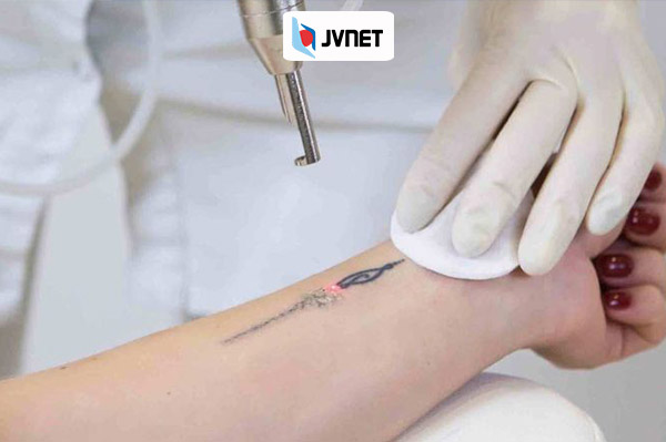 xóa xăm để đi du học nghề Đức